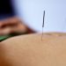 Benefits of Dry Needling Therapy: Relieve Tension and Promote Healing