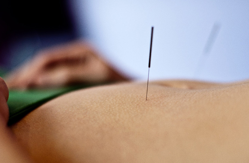 cabramatta physiotherapy, dry needling canley heights, needle, pain relief, needling, western acupuncture, Canley Heights Physiotherapy, dry needling therapy
